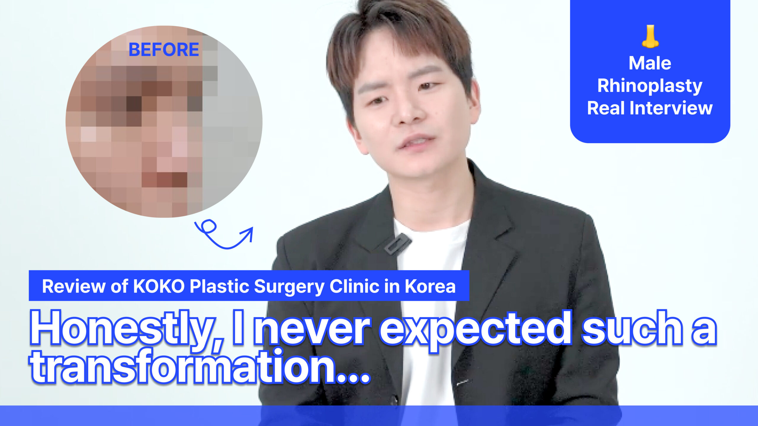 A promotional video thumbnail titled "Review of KOKO Plastic Surgery Clinic in Korea." On the left, a pixelated "before" photo shows a man's nose profile. On the right, the man is shown after his procedure with a more defined nose. Large white text at the bottom reads, "Honestly, I never expected such a transformation..." A blue badge in the corner says "Male Rhinoplasty Real Interview."