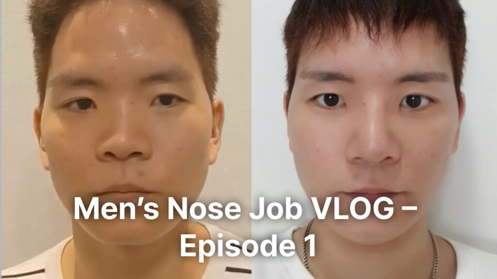 A video thumbnail showing a front-facing comparison of a male patient. The left side shows his nose before surgery (bulbous and wide), and the right side shows a slimmer, more defined nose bridge and tip after the procedure. The overlay text says "Men's Nose Job VLOG – Episode 1." | Korea's Top Nose Revision Specialist