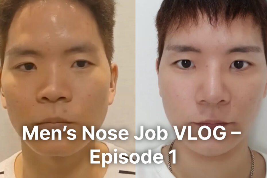 A video thumbnail showing a front-facing comparison of a male patient. The left side shows his nose before surgery (bulbous and wide), and the right side shows a slimmer, more defined nose bridge and tip after the procedure. The overlay text says "Men's Nose Job VLOG – Episode 1."