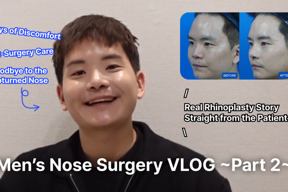 Here is the alternative text for the image in English, organized for clarity: English Alternative Text (Alt Text) A YouTube thumbnail for a men's rhinoplasty vlog featuring a personal surgery review. Main Subject: A smiling young man in a black jacket is centered, looking directly at the camera. Top Right (Comparison): A "Before" and "After 30 Days" side-by-side profile comparison showing the results of his nose surgery. Text Overlays: Main Title (Bottom): "Men’s Nose Surgery VLOG ~Part 2~" Key Points (Top Left, Blue Text): "3 Days of Discomfort," "Post-Surgery Care," and "Goodbye to the Upturned Nose." Review Note (Center Right): "Real Rhinoplasty Story Straight from the Patient."