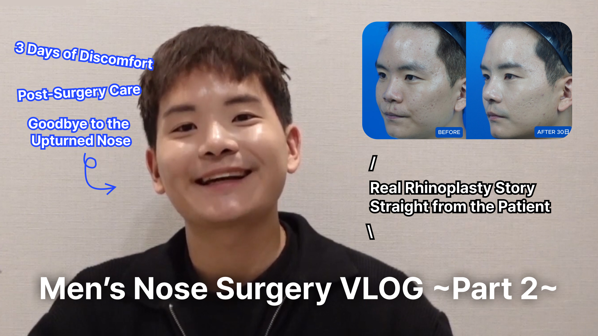 en Mens Nose Surgery VLOG ~Part 2~ | Korea's Top Nose Revision Specialist Here is the alternative text for the image in English, organized for clarity: English Alternative Text (Alt Text) A YouTube thumbnail for a men's rhinoplasty vlog featuring a personal surgery review. Main Subject: A smiling young man in a black jacket is centered, looking directly at the camera. Top Right (Comparison): A "Before" and "After 30 Days" side-by-side profile comparison showing the results of his nose surgery. Text Overlays: Main Title (Bottom): "Menβs Nose Surgery VLOG ~Part 2~" Key Points (Top Left, Blue Text): "3 Days of Discomfort," "Post-Surgery Care," and "Goodbye to the Upturned Nose." Review Note (Center Right): "Real Rhinoplasty Story Straight from the Patient." | Korea's Top Nose Revision Specialist