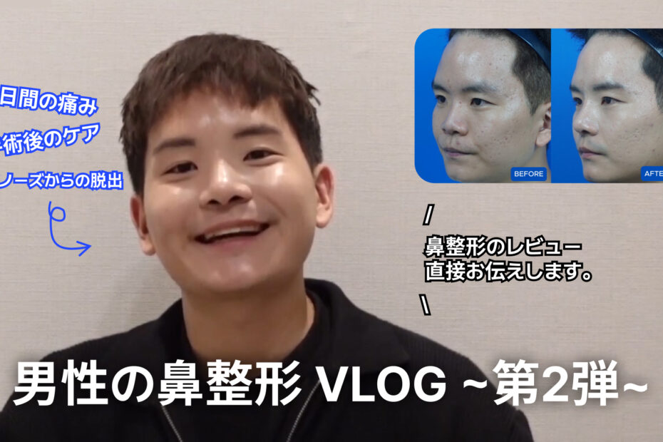 男性の鼻整形VLOG（ビデオブログ）のYouTubeサムネイル画像。 中央: 笑顔で話している若い男性の姿。 右上: 整形前（BEFORE）と30日後（AFTER 30日）の鼻の横顔を比較したビフォーアフター写真。 テキスト内容: 中央下部（大文字）: 「男性の鼻整形 VLOG ～第2弾～」 左上（青文字）: 「3日間の痛み」「手術後のケア」「アップノーズからの脱出」 中央右側: 「鼻整形のレビュー直接お伝えします。」
