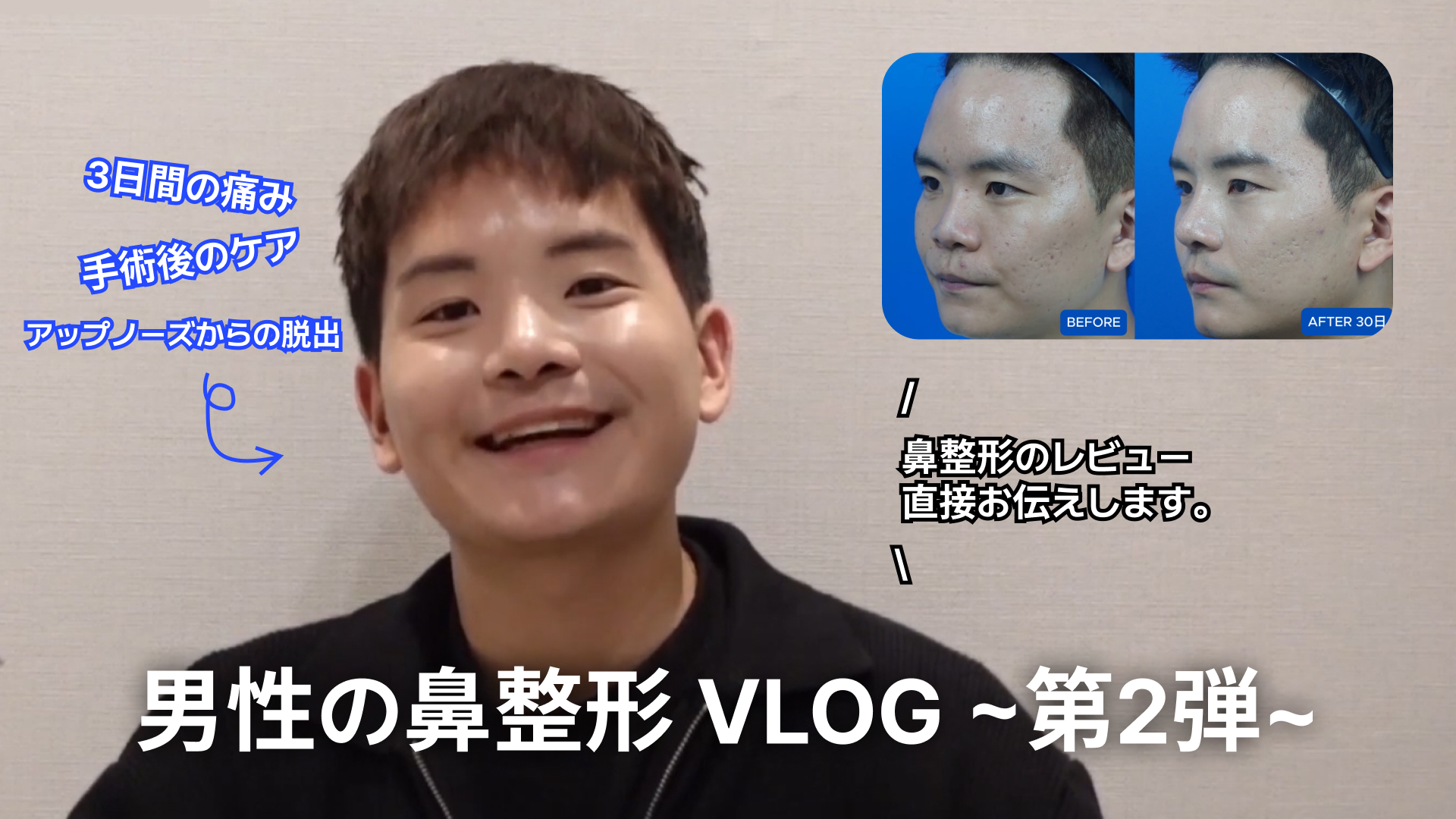 jp_男性の鼻整形 VLOG ~第2弾~ | Korea's Top Nose Revision Specialist 男性の鼻整形VLOG(ビデオブログ)のYouTubeサムネイル画像。 中央: 笑顔で話している若い男性の姿。 右上: 整形前(BEFORE)と30日後(AFTER 30日)の鼻の横顔を比較したビフォーアフター写真。 テキスト内容: 中央下部(大文字): 「男性の鼻整形 VLOG ~第2弾~」 左上(青文字): 「3日間の痛み」「手術後のケア」「アップノーズからの脱出」 中央右側: 「鼻整形のレビュー直接お伝えします。」 | Korea's Top Nose Revision Specialist