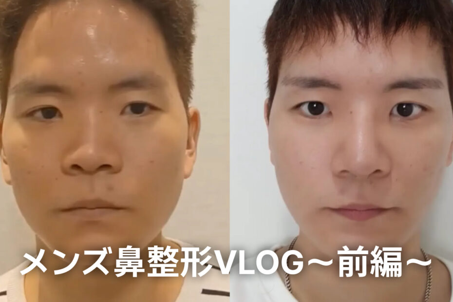 男性が鼻整形を受ける前と後の正面写真を並べた比較画像。左側は手術前、右側は手術後のスッキリとした鼻筋を強調しています。下部には「メンズ鼻整形VLOG〜前編〜」という白い文字のタイトルが記載されています。