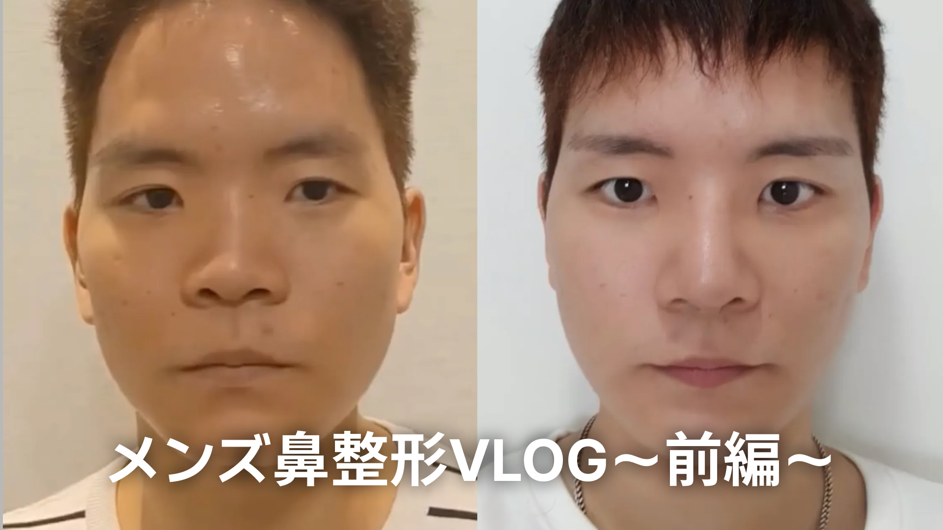 メンズ鼻整形Vlogもう豚鼻なんて言わせないアップノーズ広がった鼻翼の手術を決心したストーリーft 韓国鼻整形名医 | Korea's Top Nose Revision Specialist 男性が鼻整形を受ける前と後の正面写真を並べた比較画像。左側は手術前、右側は手術後のスッキリとした鼻筋を強調しています。下部には「メンズ鼻整形VLOG〜前編〜」という白い文字のタイトルが記載されています。