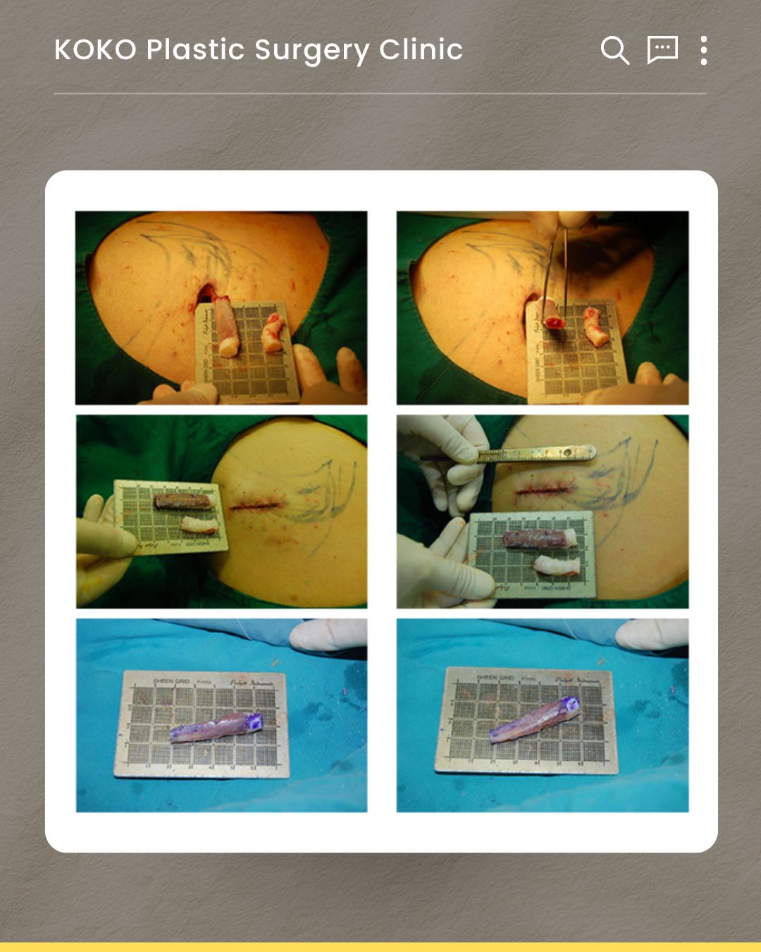 A collage of six surgical photographs demonstrating the harvesting of autologous rib cartilage. The top and middle rows display a small incision on a patient's chest and the extracted piece of rib cartilage held with forceps. The bottom row shows the harvested rib cartilage segment placed on a metallic surgical measuring grid, marked with purple surgical ink for precise shaping.