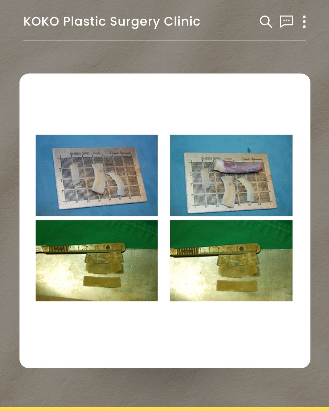 A collage of four surgical photographs showing the detailed processing of the harvested rib cartilage. The top row shows the cartilage after it has been carved into thinner, curved segments, resting on a surgical measuring grid. The bottom row shows these carved cartilage pieces being precisely measured with a metal surgical ruler to ensure accurate sizing for the nasal reconstruction.