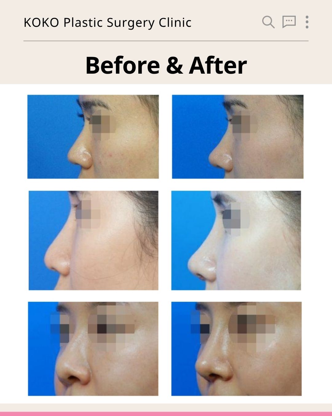  | Korea's Top Nose Revision Specialist