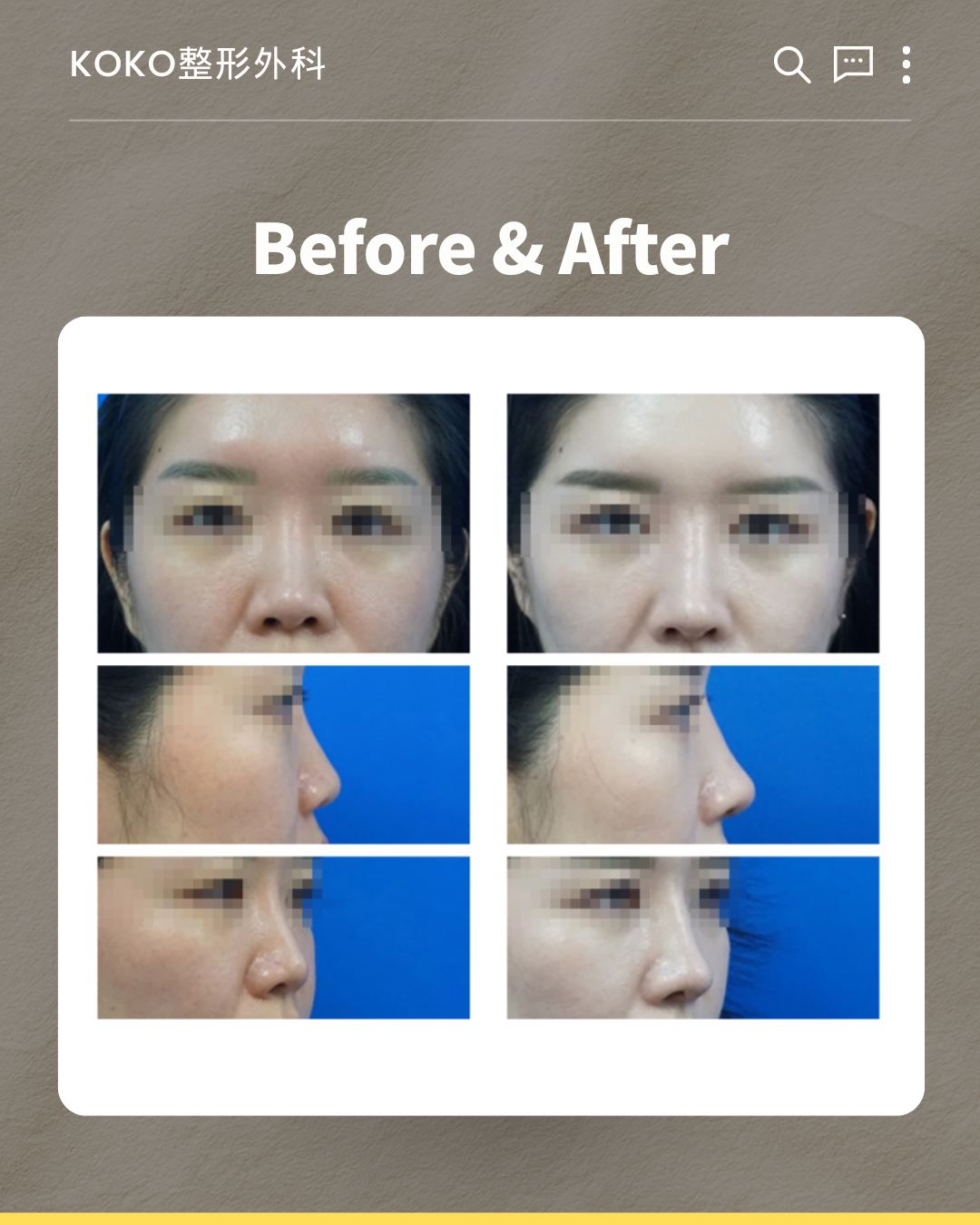 KOKO整形外科（코코성형외과）的鼻部整形手术“Before & After”（术前术后）对比拼图，包含6张患者面部照片。左侧三张为术前（正面、侧面、半侧面），显示鼻梁较低、鼻尖较塌；右侧三张为术后相同角度的照片，显示鼻梁和鼻尖变得更加立体和挺拔。