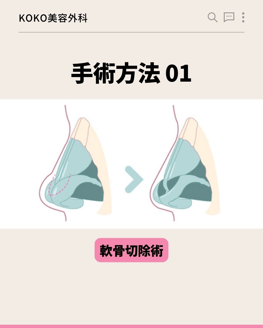 KOKO美容外科の「手術方法 01」を説明する画像。鼻の側面からの断面イラストが描かれており、余分な軟骨の点線部分を切り取る前と後の変化が矢印で示されています。下部にはピンク色の背景で「軟骨切除術」と書かれています。