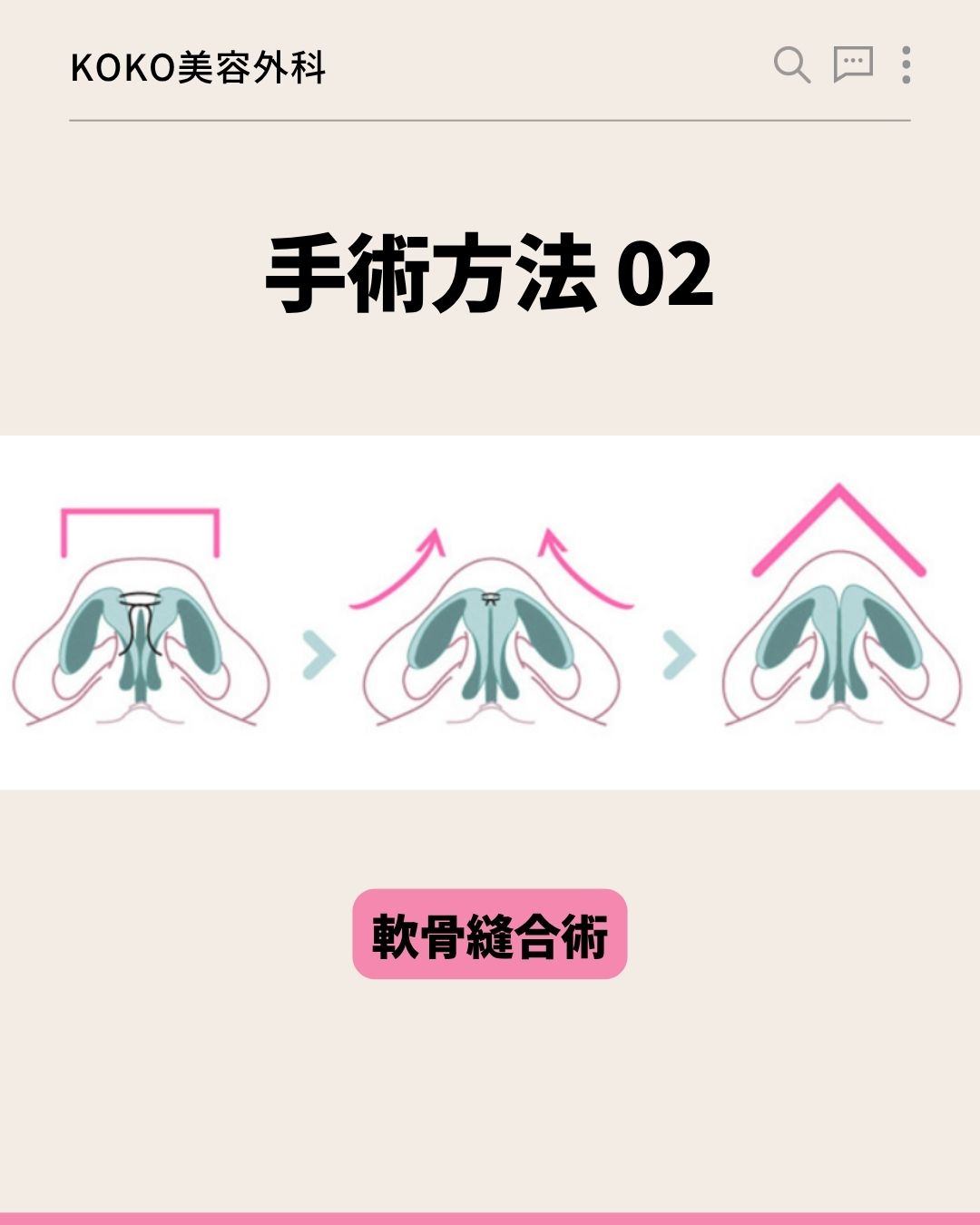 KOKO美容外科の「手術方法 02」を説明する画像。鼻の軟骨の正面（または下から見た）イラストが描かれています。広がった軟骨を中央に寄せて結び、鼻先を高くする過程が3段階のイラストと矢印で示されています。下部にはピンク色の背景で「軟骨縫合術」と書かれています。