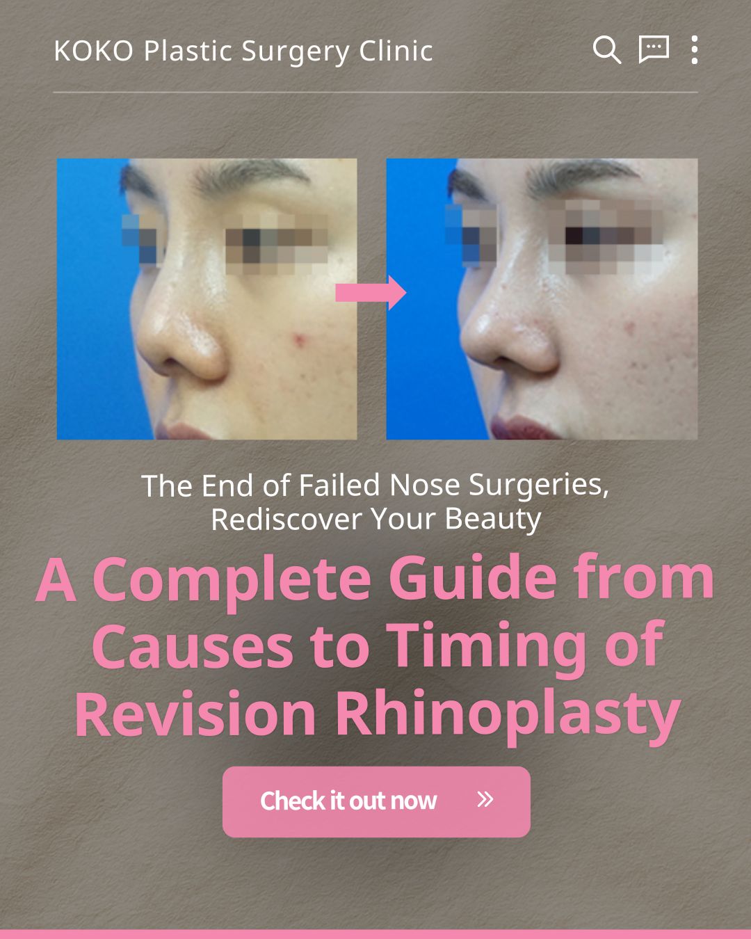 An infographic from KOKO Plastic Surgery Clinic titled "Issues with Implants and Their Position." It visually lists four surgical complications from top to bottom, pairing a photo with text: "When the Implant Itself is Bent" features a diagram of a curved implant inside the nose; "When the Actual Nose Axis is Bent" shows an S-shaped deviation of the nose bridge; "When the Skin Becomes Thinner" displays a reddened, sensitive-looking nose tip; and "When the Implant Moves Excessively" uses contour lines to indicate shifting and instability of the implant. | Korea's Top Nose Revision Specialist
