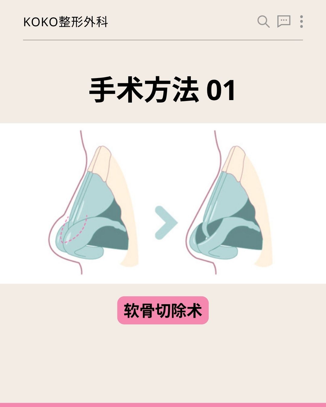 KOKO整形外科关于“手术方法 01”的图解说明。图片展示了鼻部侧面的透视示意图，通过箭头对比演示了将鼻头部位多余的软骨进行切除的过程，以缩小鼻尖体积。最下方配有粉色底黑字的标签：“软骨切除术”。
