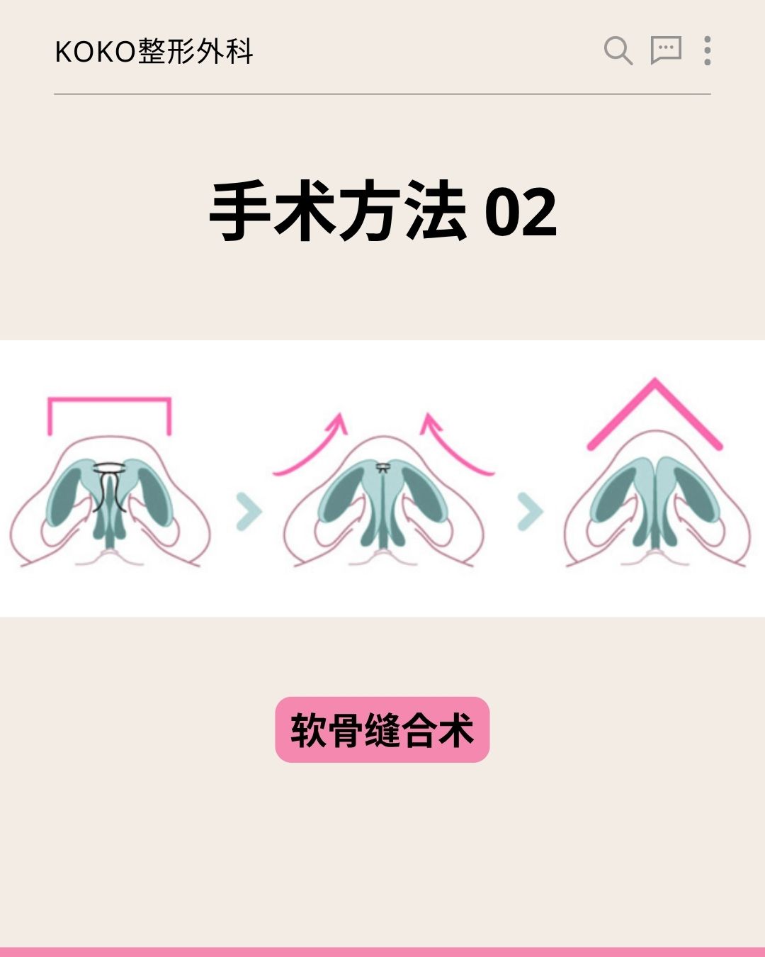 KOKO整形外科关于“手术方法 02”的图解说明。图片从仰视角度（鼻孔视角）展示了鼻部软骨的形态变化，通过三个阶段的示意图和粉色箭头，演示了将原本宽平、向两侧分散的鼻翼软骨向中间聚拢并缝合，从而使鼻尖变得尖挺的过程。最下方配有粉色底黑字的标签：“软骨缝合术”。