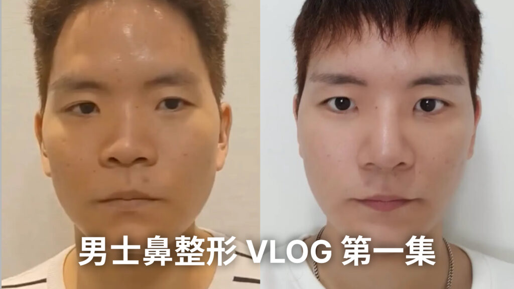  | Korea's Top Nose Revision Specialist