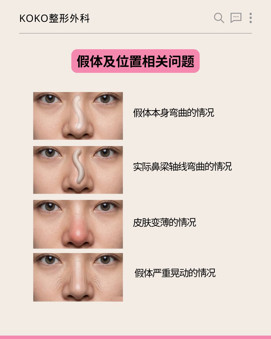KOKO整形外科关于“假体及位置相关问题”的图解说明。从上到下展示了四种鼻部不良情况的配图与文字： 假体本身弯曲的情况：配有鼻部内假体呈弯曲状的透视示意图。 实际鼻梁轴线弯曲的情况：配有鼻梁呈S型弯曲的透视示意图。 皮肤变薄的情况：配有鼻尖皮肤泛红、变薄的实拍图。 假体严重晃动的情况：配有表示假体在鼻部内不稳定、晃动的示意图。