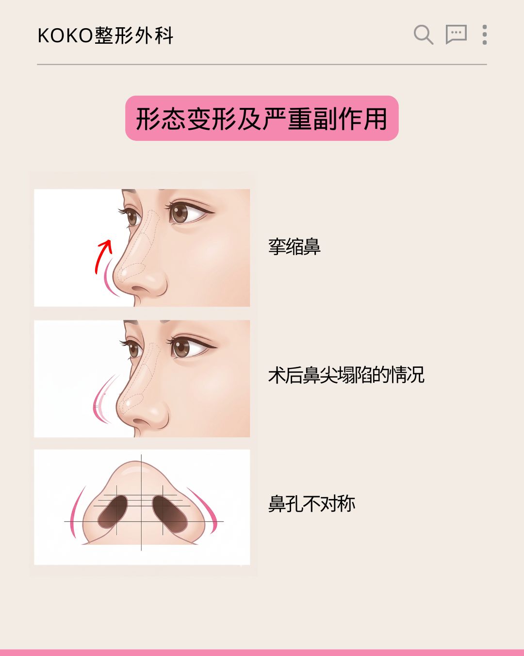 KOKO整形外科关于“形态变形及严重副作用”的图解说明。从上到下展示了三种鼻部严重副作用的插画与文字： 挛缩鼻：插画展示鼻尖向上挛缩、变短的情况。 术后鼻尖塌陷的情况：插画展示鼻尖下移、塌陷的情况。 鼻孔不对称：插画从仰视角度展示两侧鼻孔大小和形状不一致的情况。