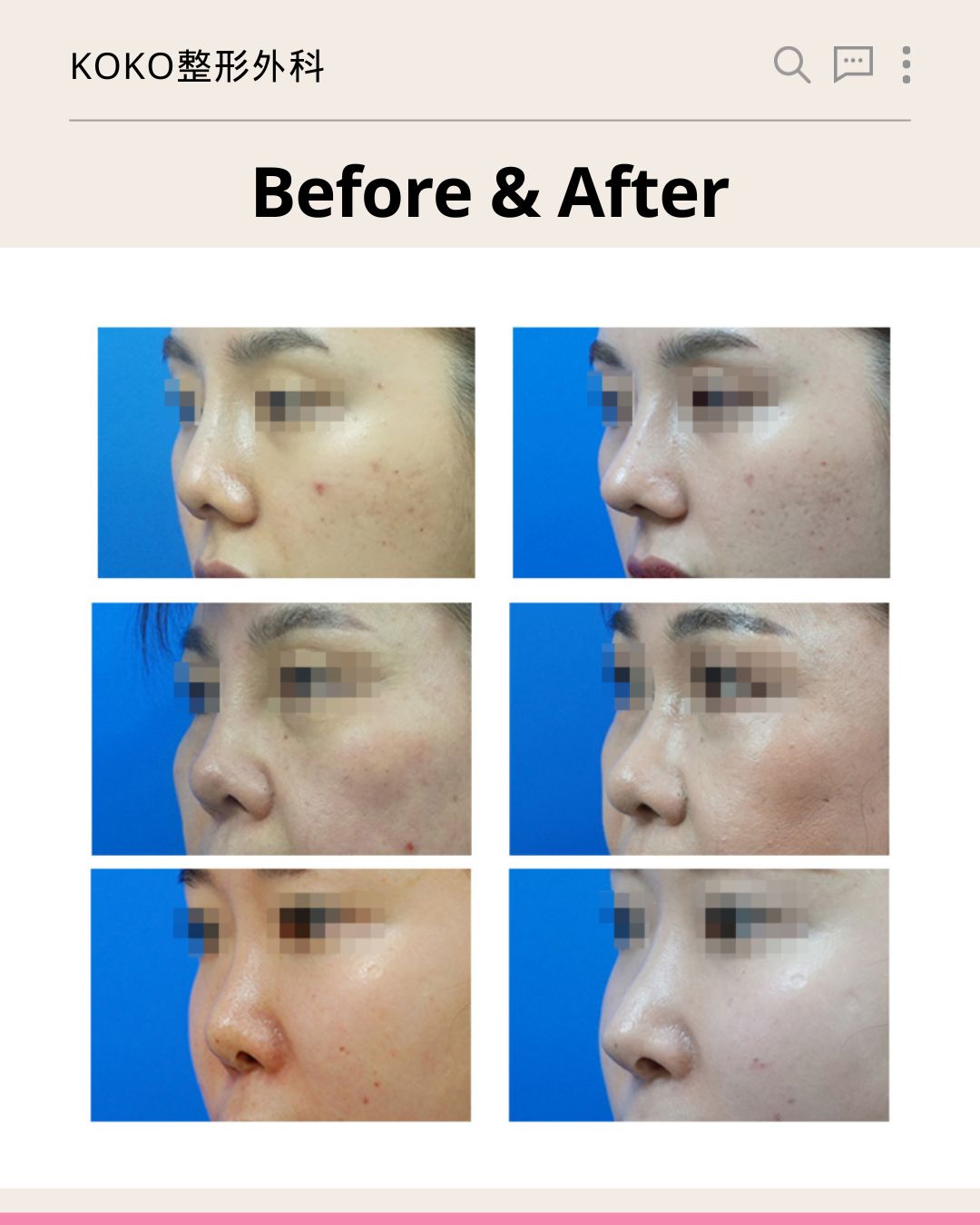 KOKO整形外科的“Before & After”真实案例对比图。图片包含三组女性患者的鼻部整形前后侧脸对比照（左侧为术前，右侧为术后）。三组对比均展示了术后鼻梁垫高、鼻型改善的效果。所有患者的眼部均已做马赛克隐私处理。