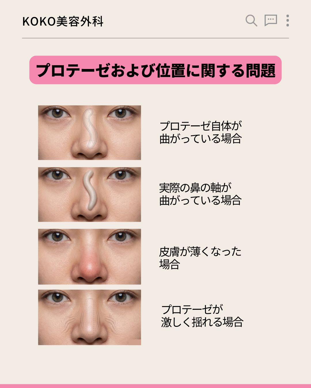 鼻の再手術の原因から時期までの完全ガイド 2 | Korea's Top Nose Revision Specialist 「プロテーゼおよび位置に関する問題」を説明する4つの症例写真。上から順に「プロテーゼ自体が曲がっている場合」「実際の鼻の軸が曲がっている場合」「皮膚が薄くなった場合」「プロテーゼが激しく揺れる場合」というテキストと、それぞれの状態を示す鼻のクローズアップ写真が並んでいる。