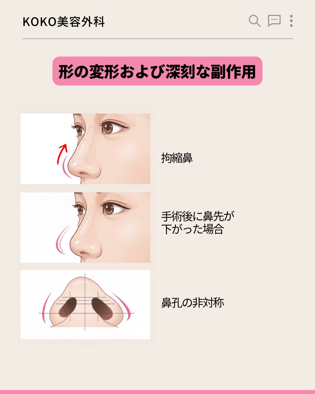鼻の再手術の原因から時期までの完全ガイド 3 | Korea's Top Nose Revision Specialist 「形の変形および深刻な副作用」を説明する3つのイラスト。上から順に、鼻先が上を向いた「拘縮鼻」、鼻先が垂れ下がった「手術後に鼻先が下がった場合」、下から見た状態の「鼻孔の非対称」というテキストと、それぞれの状態を分かりやすく図解したイラストが並んでいる。