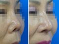 鼻の再手術(拘縮鼻）